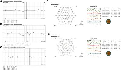 Deciphering complexity: TULP1 variants linked to an atypical retinal dystrophy phenotype